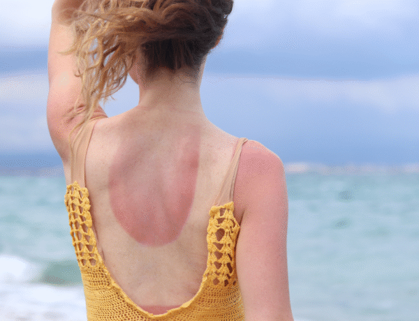 femme avec des coups de soleil dans le dos et sur les bras