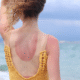femme avec des coups de soleil dans le dos et sur les bras