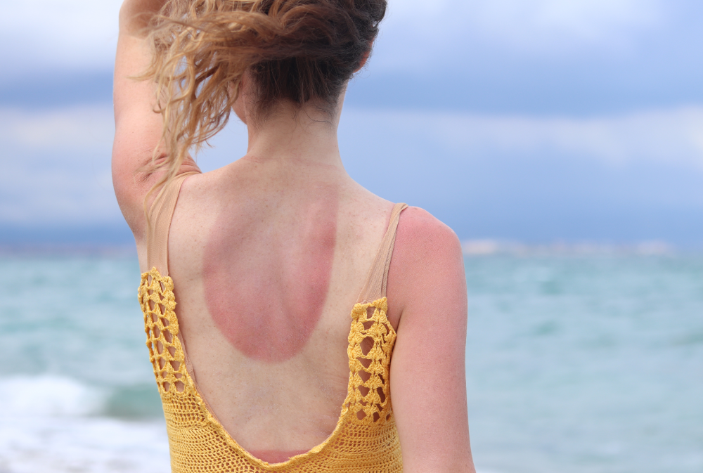 femme avec des coups de soleil dans le dos et sur les bras