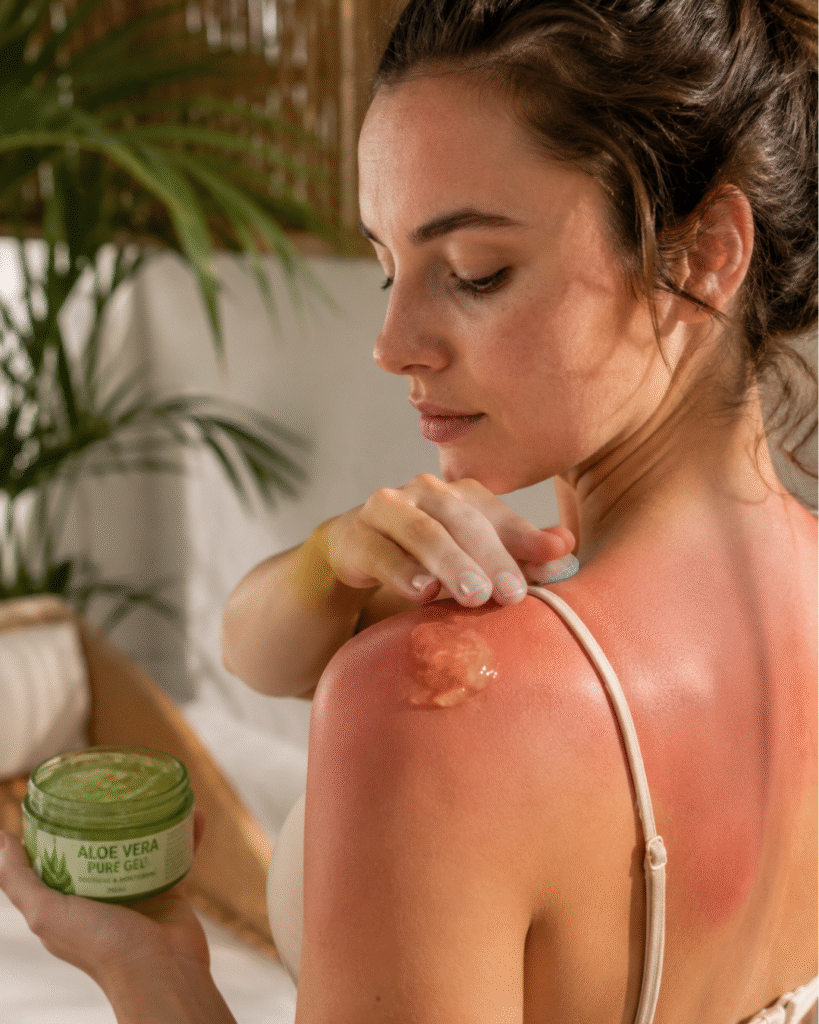 une femme avec un coup de soleil qui s'applique du gel aloe vera pur